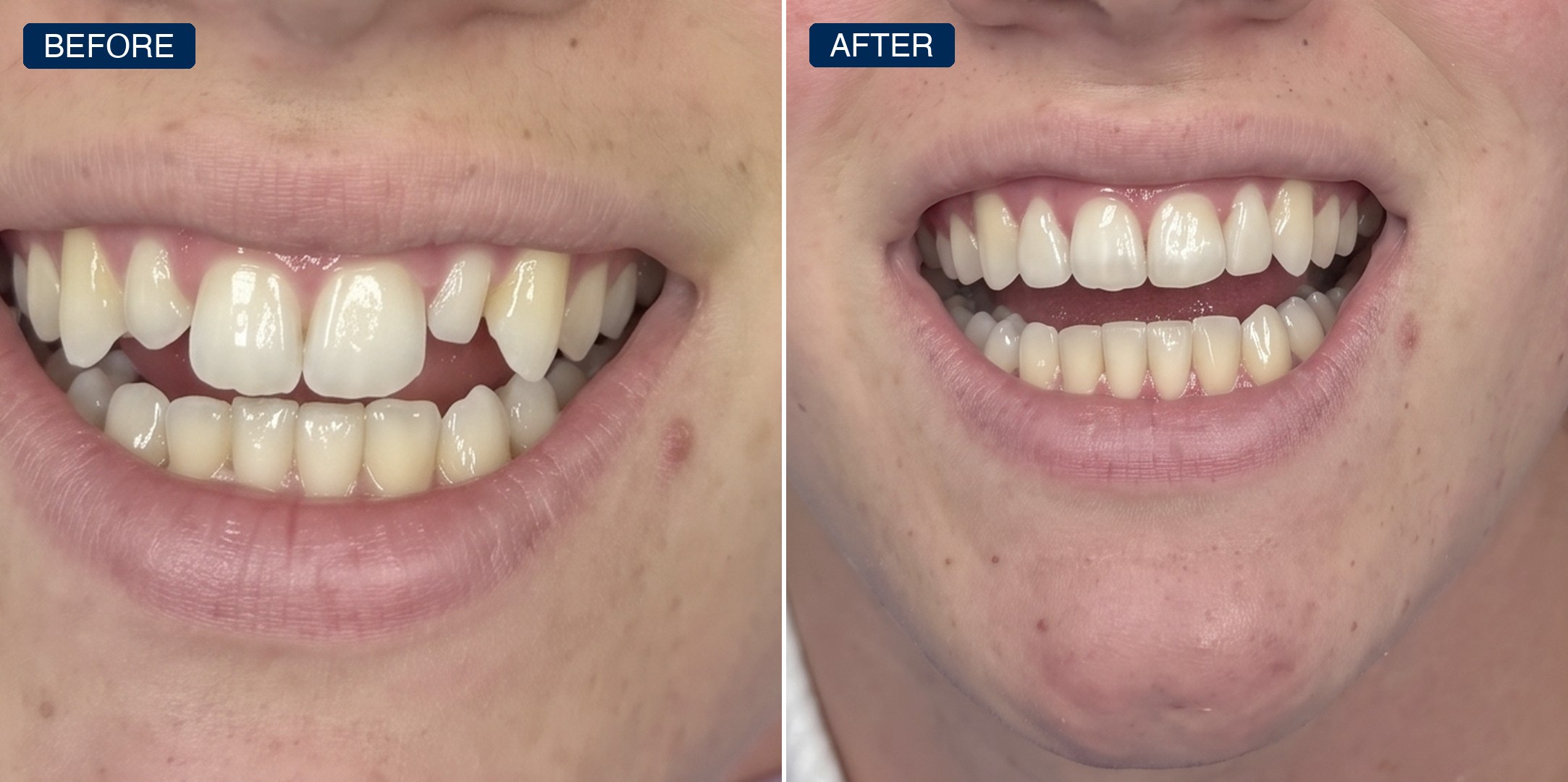 Before and after: crowded, chipped upper teeth aligned into an even smile