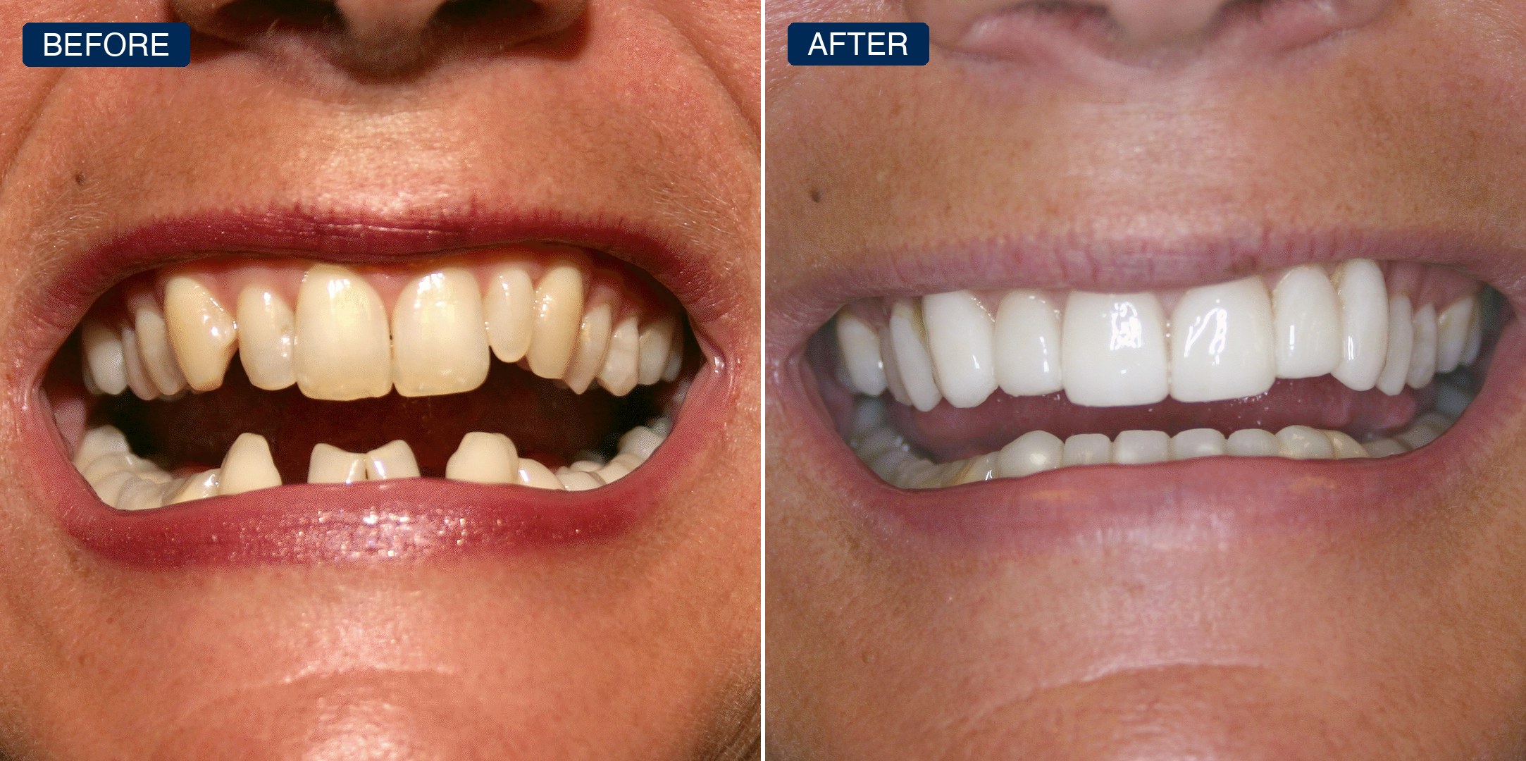 Before and after: worn, uneven, discolored upper arch restored to an even, natural result