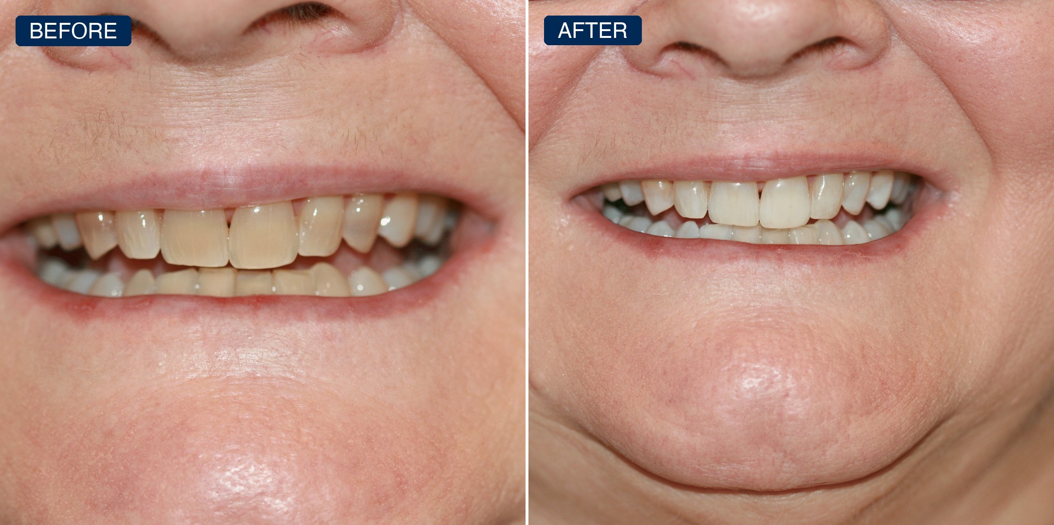 Before and after: dark, discolored front teeth restored to an even, brighter smile