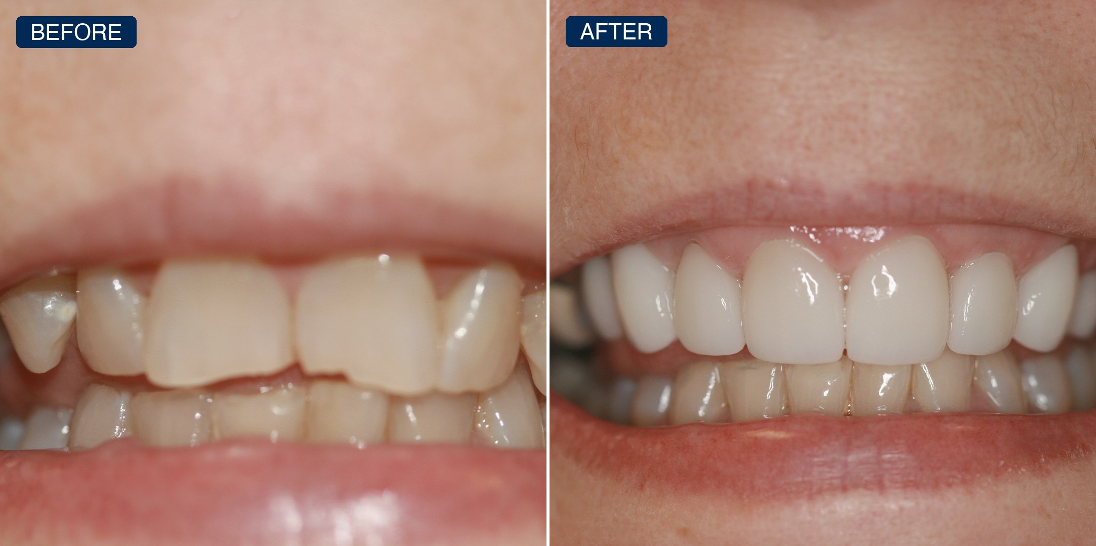 Before and after: crowded, chipped, discolored upper teeth restored to a white, even smile