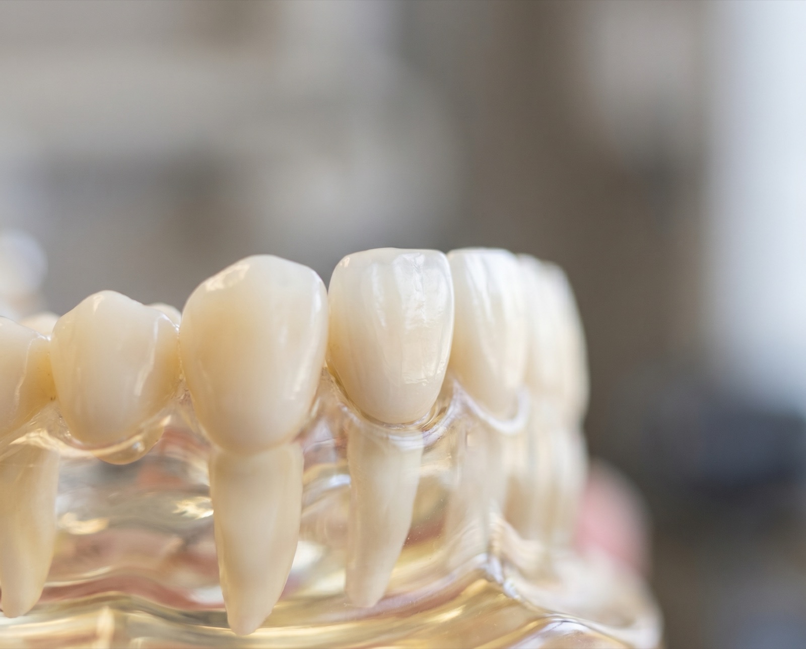 A natural-looking all-ceramic crown on a front tooth